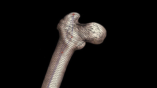 Created by Ken Lambrecht Custom hip implants CAD image